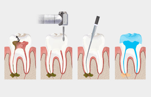 Kanal tedavisi uygulaması