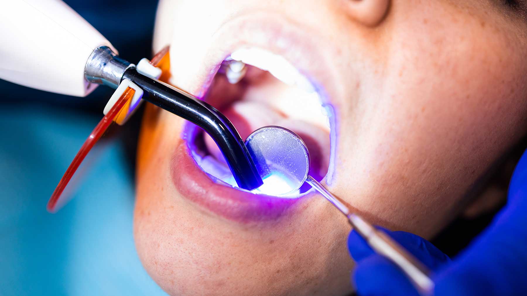 Estetik kompozit dolgu tedavisi